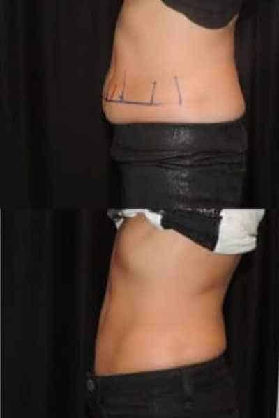HIEMT Muscle Toning Royal Leamington Spa