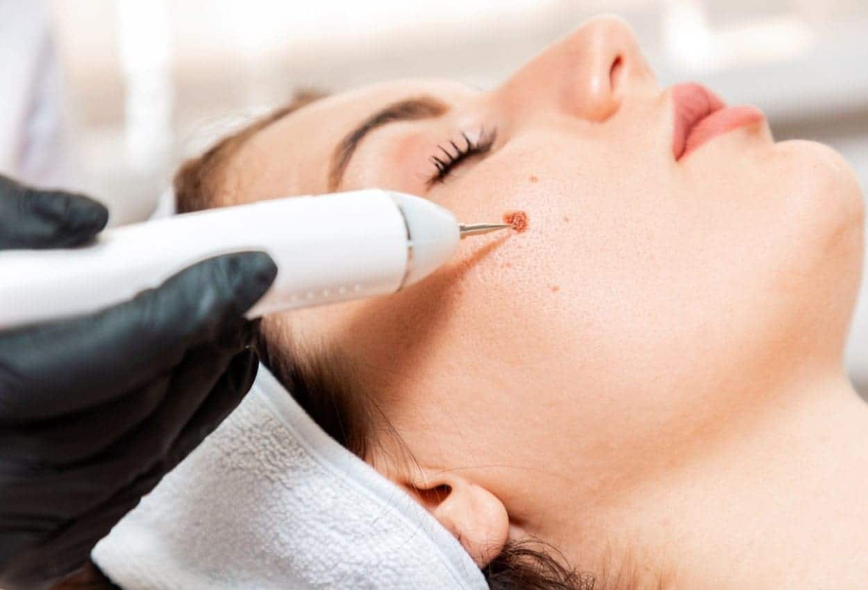 Benefits of Ephelides Treatment Royal Leamington Spa