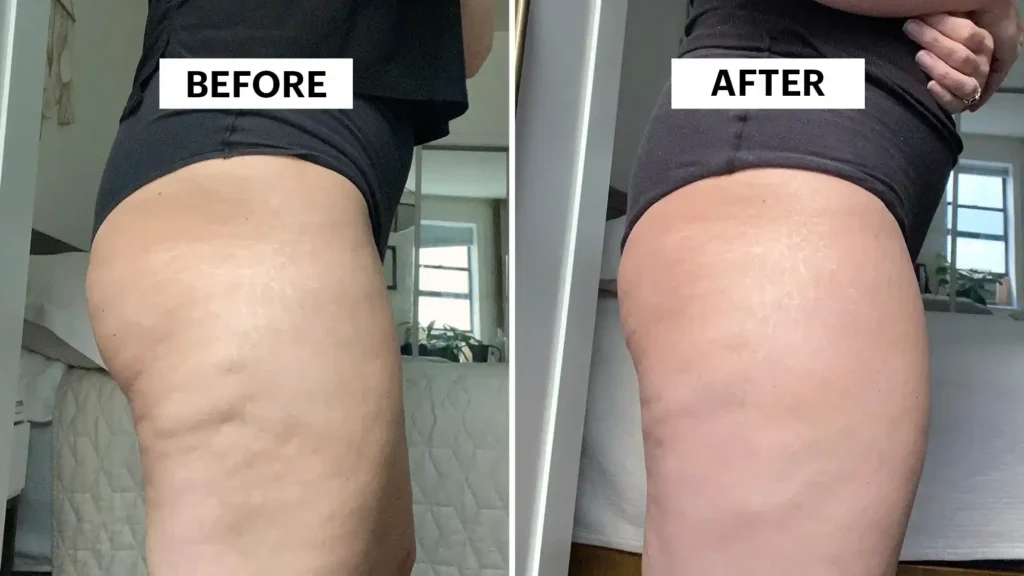 Sculpting Your Bum: Can Toning Exercises Really Reduce Cellulite? 1 Do Toning Exercise Royal Leamington Spa Really Tackle Cellulite?
