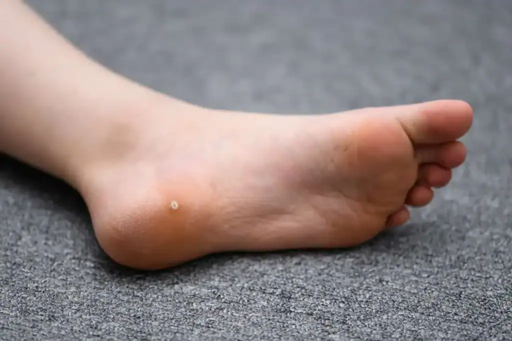 Cryotherapy For Warts And Also Verrucas 2 Image of verruca on the bottom of the foot that able to be treated with Cryotherapy Royal Leamington Spa