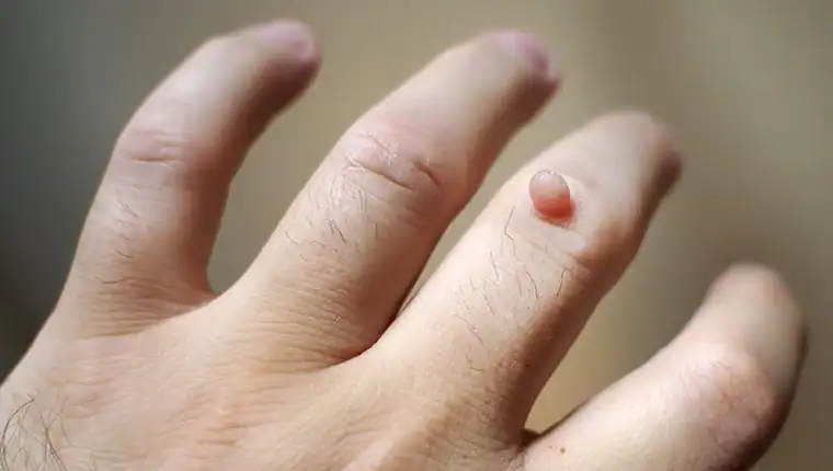 Cryotherapy For Warts And Also Verrucas 1 Image of blemish that Cryotherapy Royal Leamington Spa can remove with Lipo 360.