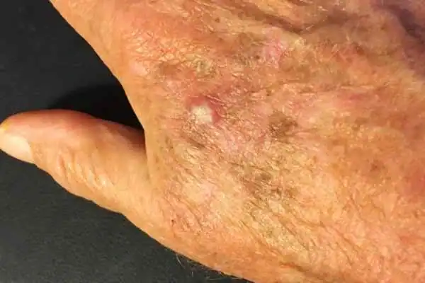 Image of Actinic keratoses Royal Leamington Spa on a person hand