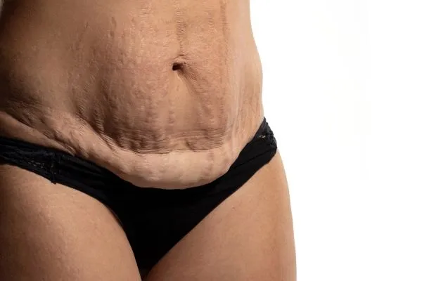 The Science of Skin Tightening 1 The science behind skin tightening Royal Leamington Spa picture of a woman's sagging skin on the stomach