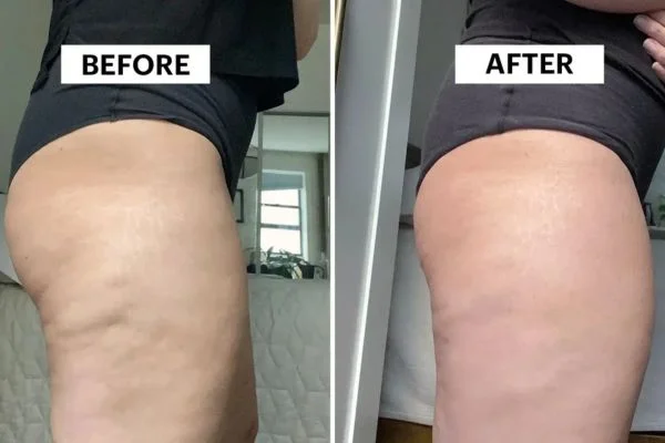 Body Sculpting Results Royal Leamington Spa