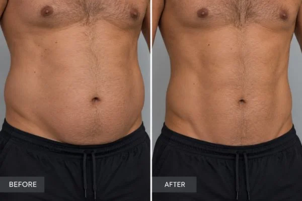 Body sculpting results Royal Leamington Spa