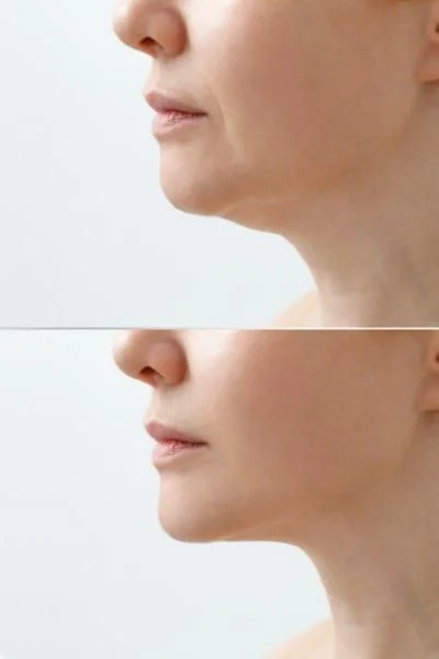 HIFU Before and after results Royal Leamington Spa