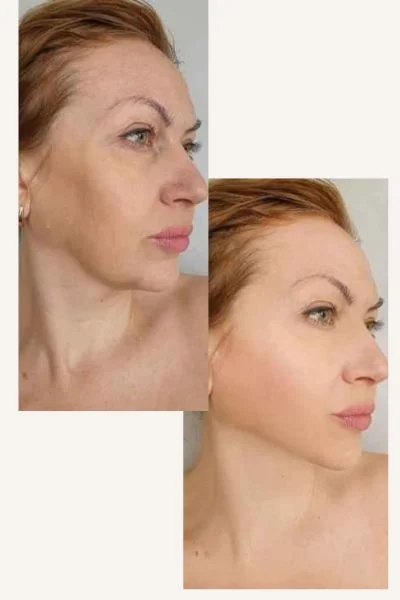 HIFU Results Royal Leamington Spa before and after