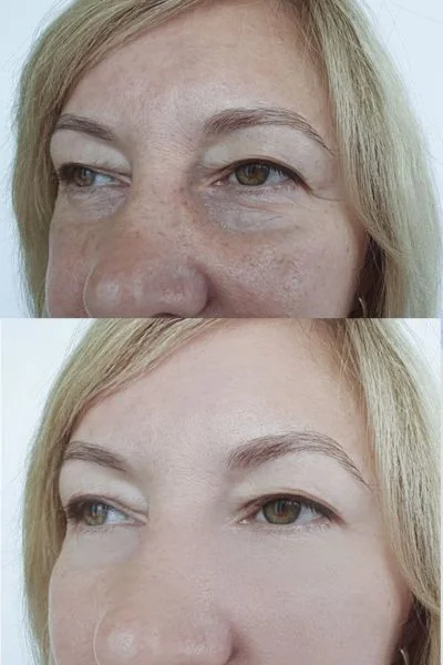 collagen lift 360 results Royal Leamington Spa